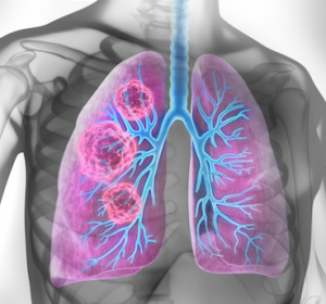 Weiterer Schritt im Kampf gegen Lungenkrebs