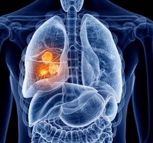 Steuermechanismus nachgewiesen, der Wachstum von Tumorzellen bei Lungenkrebspatienten hemmt