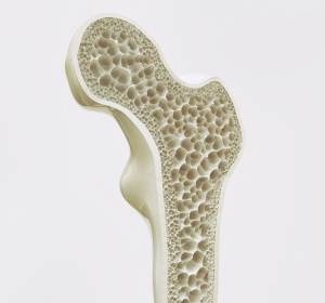 Schutz vor Osteoporose bei hormoneller Krebstherapie