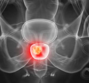Prostatakarzinom: Hinweis auf beträchtlichen Zusatznutzen durch Apalutamid