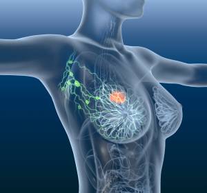 Kontinuierliche Chemotherapie bei fortgeschrittenem Brustkrebs einem intermittierenden Schema überlegen
