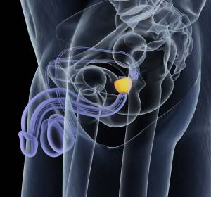 Hormonsensitives metastasiertes Prostatakarzinom: Daten der TITAN-Studie mit Apalutamid