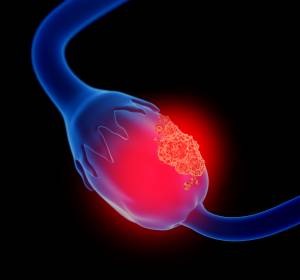 Fortgeschrittenes Ovarialkarzinom: PARP-Inhibitor Niraparib verlängert PFS signifikant  