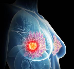 Mammakarzinom: Tumorgewebe erlaubt Krankheitsprognostik