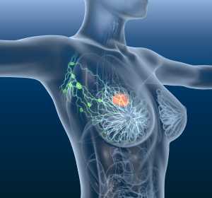 Frauen und Onkologie: Praxisnahes Update zu Mamma- und Ovarialkarzinom