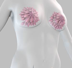Brustkrebs: Strategien zur Individualisierung des Bestrahlungsfeldes