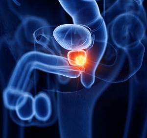 Prostatakarzinom: ADT als Therapiestandard 
