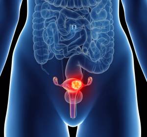 S3-Leitlinie „Diagnostik, Therapie und Nachsorge maligner Ovarialtumoren“ aktualisiert