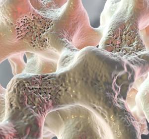 Osteoporose und Krebs: Gefahr der Kiefernekrose