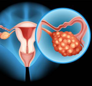Ovarialkarzinom: Erhaltungstherapieoptionen für Patientinnen mit fortgeschrittenen Tumoren