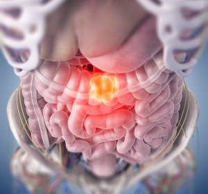 Gastrointestinale Tumoren: Highlights vom virtuellen Gastrointestinal Cancers Symposium