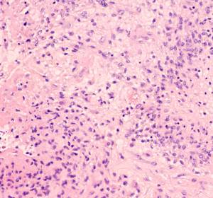 TAMEP-Zellen als Tumortreiber: Möglicher Ansatz gegen Glioblastome