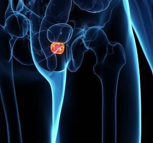 Prostatakarzinom: Nutzen der Fusionsbiopsie nicht ausreichend belegt