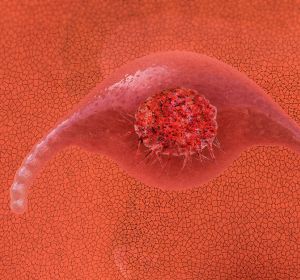 Cemiplimab mono bei fortgeschrittenem Zervixkarzinom: Phase-III-Studie wegen positiver Ergebnisse vorzeitig beendet