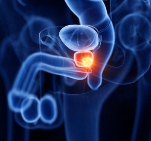 Prostatakarzinom mit Knochenmetastasen: Neuropilin 2-Inhibition innovative Behandlungsmethode