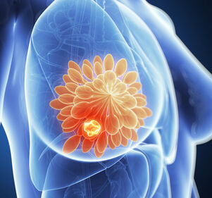 HR+ HER2- Brustkrebs: Wer braucht tatsächlich eine Chemotherapie?