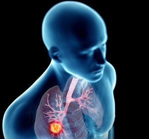 Plattenepithel-, Adeno- oder großzelliges Karzinom? Lungenkarzinom individualisiert behandeln!