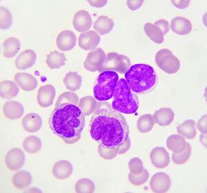 CAR-T-Zellen und bispezifische Antikörper bei rezidiviertem follikulären Lymphom