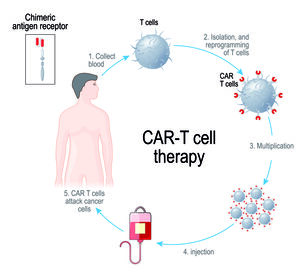 CAR-T-Zell-Therapie neu beim LBCL
