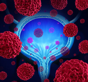 Blasenkrebs: Wirkstoffe mit therapeutischem Effekt identifiziert
