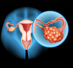 Endometriumkarzinom: Zusatznutzen für Lenvatinib + Pembrolizumab