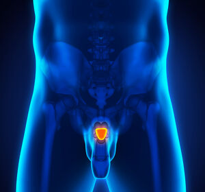 Wie gelingt die Osteoprotektion beim Prostatakarzinom?
