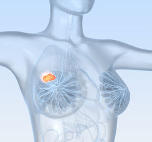 ER-positiver, HER2-negativer Brustkrebs: Neoadjuvante Behandlung mit Giredestrant