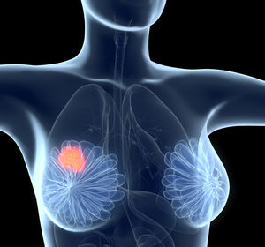 Olaparib: Zulassung bietet Patientinnen mit BRCA1/2-mutiertem HER2-negativen Mammakarzinom im Frühstadium eine neue Behandlungsoption