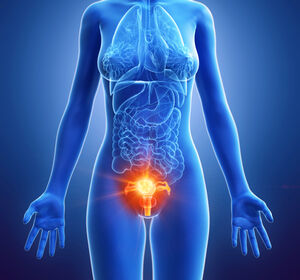 Endometriumkarzinom: Aktualisierte S3-Leitlinie stärkt Bedeutung der molekularen Tumor-Klassifikation und der Immuntherapien