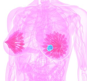 HR+/HER2- Brustkrebs: Ursachen für schlechteres Therapieergebnis bei non-hispanic black-Patientinnen auf der Spur