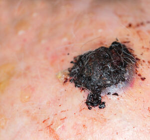 Elektrochemotherapie mit lokaler Infusion bei Hautkrebs