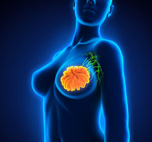 HR+ Brustkrebs: Längeres PFS mit Camizestrant im Vergleich zu Fulvestrant