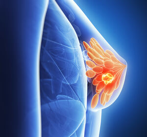 Ribociclib: PFS-Vorteil bei aggressivem HR+/HER2- metastasiertem Brustkrebs 