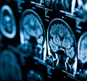 Präzise Unterscheidung von Hirntumoren mit Deep Learning und Radiomics