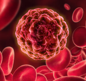 Akute Myeloische Leukämie: Zuerst Stammzelltransplantation oder Chemotherapie?