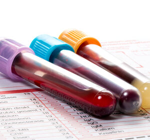 Krebsdiagnose: Bluttest macht Biopsien überflüssig