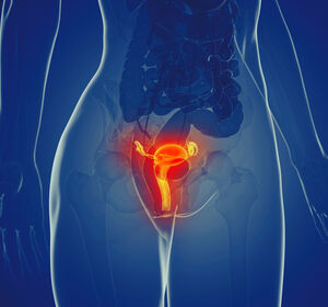Endometriumkarzinom: PFS-Verbesserung mit Pembrolizumab + Chemotherapie unabhängig vom Mismatch-Reparatur-Status