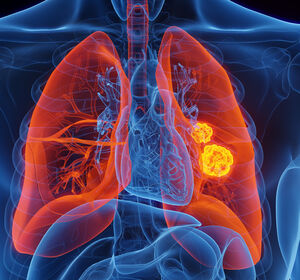 Lungenkrebs: Mehr Lebensqualität und bessere Überlebenschancen