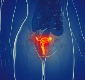 Endometriumkarzinom: PFS-Verbesserung mit Durvalumab + Olaparib und Durvalumab allein in Kombination mit Chemotherapie