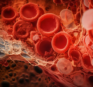 Niedrigrisiko-MDS: Luspatercept in der Erstlinie verbessert Anämie und senkt Transfusionsabhängigkeit
