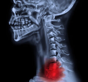 Plattenepithelkarzinom im Kopf-Hals-Bereich: Kann eine Apoptose-fördernde Substanz die Wirkung der RCT verbessern?