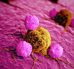 Solide Tumoren: NK-Zellen mit Hydrogel können malignes Gewebe angreifen
