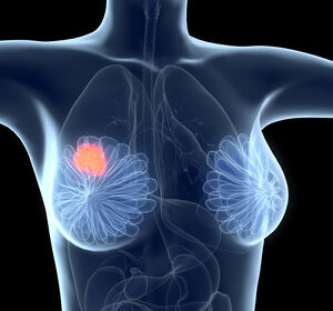 Zulassung für Sacituzumab govitecan bei Brustkrebs erweitert