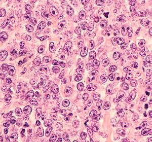 B-Zell-Lymphom: Zweitlinie mit Lisocabtagen maraleucel – Zusatznutzen für bestimmtes Patientenkollektiv