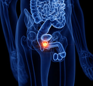 Fortgeschrittenes Prostatakarzinom: PSMA-Theranostik – Immer wichtiger in Diagnostik und Therapie