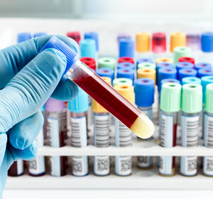 Begleitdiagnostik als Treiber onkologischer Therapien: Welche Tests Ihre Erfolgsaussichten erhöhen können