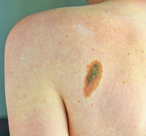 KI erkennt Hautkrebs-Metastasen in Lymphknoten
