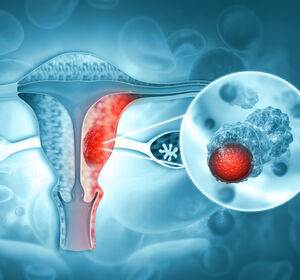 Endometriumkarzinom: Überlebensvorteil durch Immuntherapie plus PARP-Inhibition 