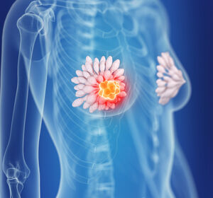 NATALEE-Studie: Ribociclib reduziert Rezidivrisiko bei frühem HR+/HER2- Brustkrebs