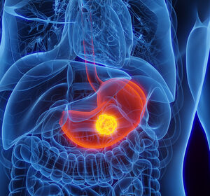 Magenkarzinom: Pembrolizumab verlängert das Leben unabhängig vom HER2-Status